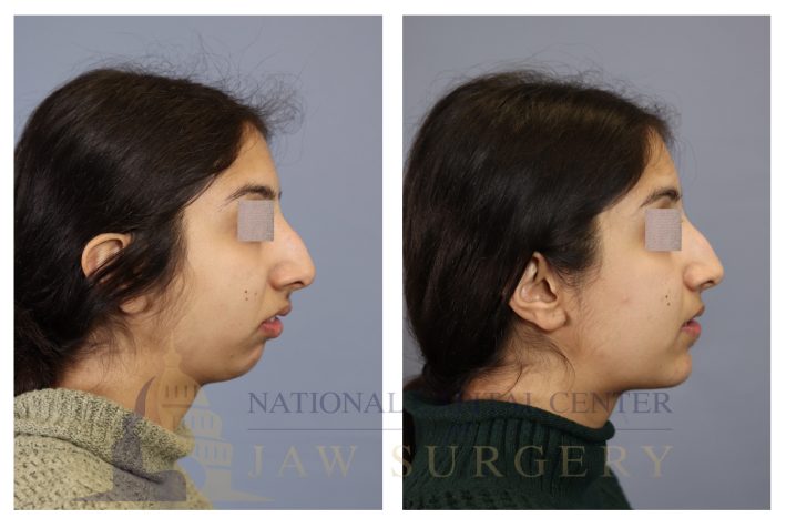 Side profile of a patient before and after upper jaw and chin surgery
